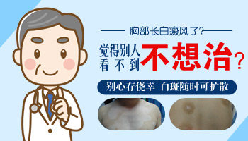 白癜风症状怎么传染